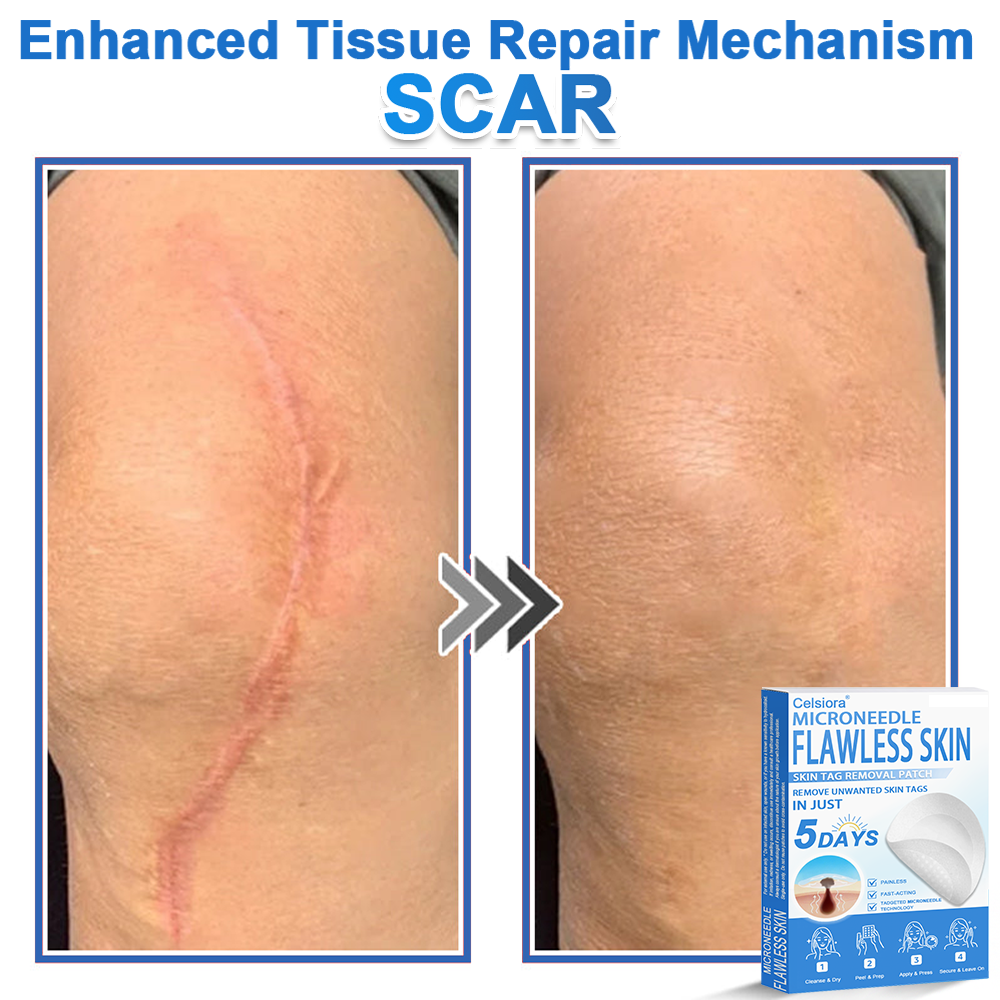 2-in-1 Microneedle & Hydrocolloid Patch | Raised Moles,Acne, Flat Warts & Skin Tags Remover | Improves Wrinkles, Scars & Blemishes | Invisible Star Pimple Patches for Face & Body