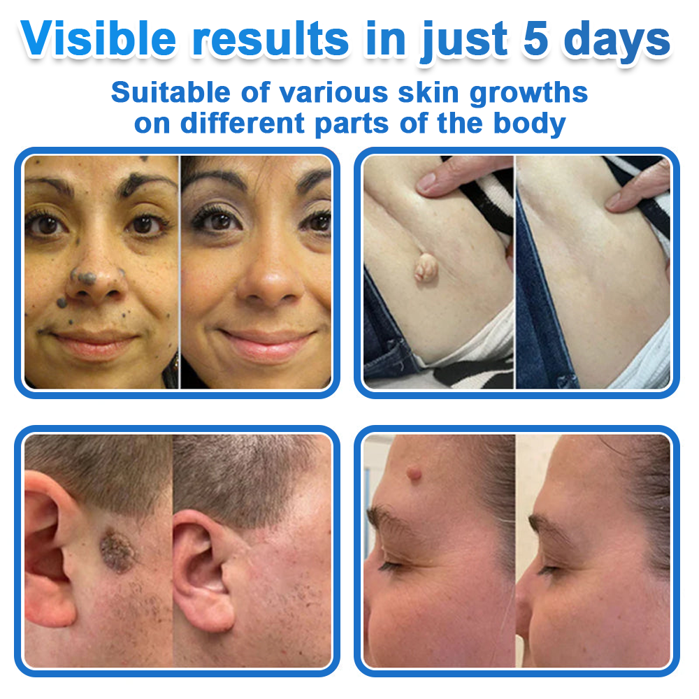 2-in-1 Microneedle & Hydrocolloid Patch | Raised Moles,Acne,  Flat Warts & Skin Tags Remover | Improves Wrinkles, Scars & Blemishes | Invisible Star Pimple Patches for Face & Body